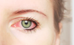 Home Remedies for Eye Infections
