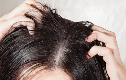 How can I get rid of Dandruff at home